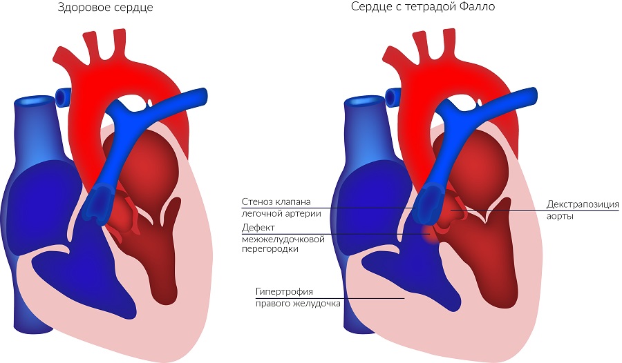 Fallot_tetralogy.jpg