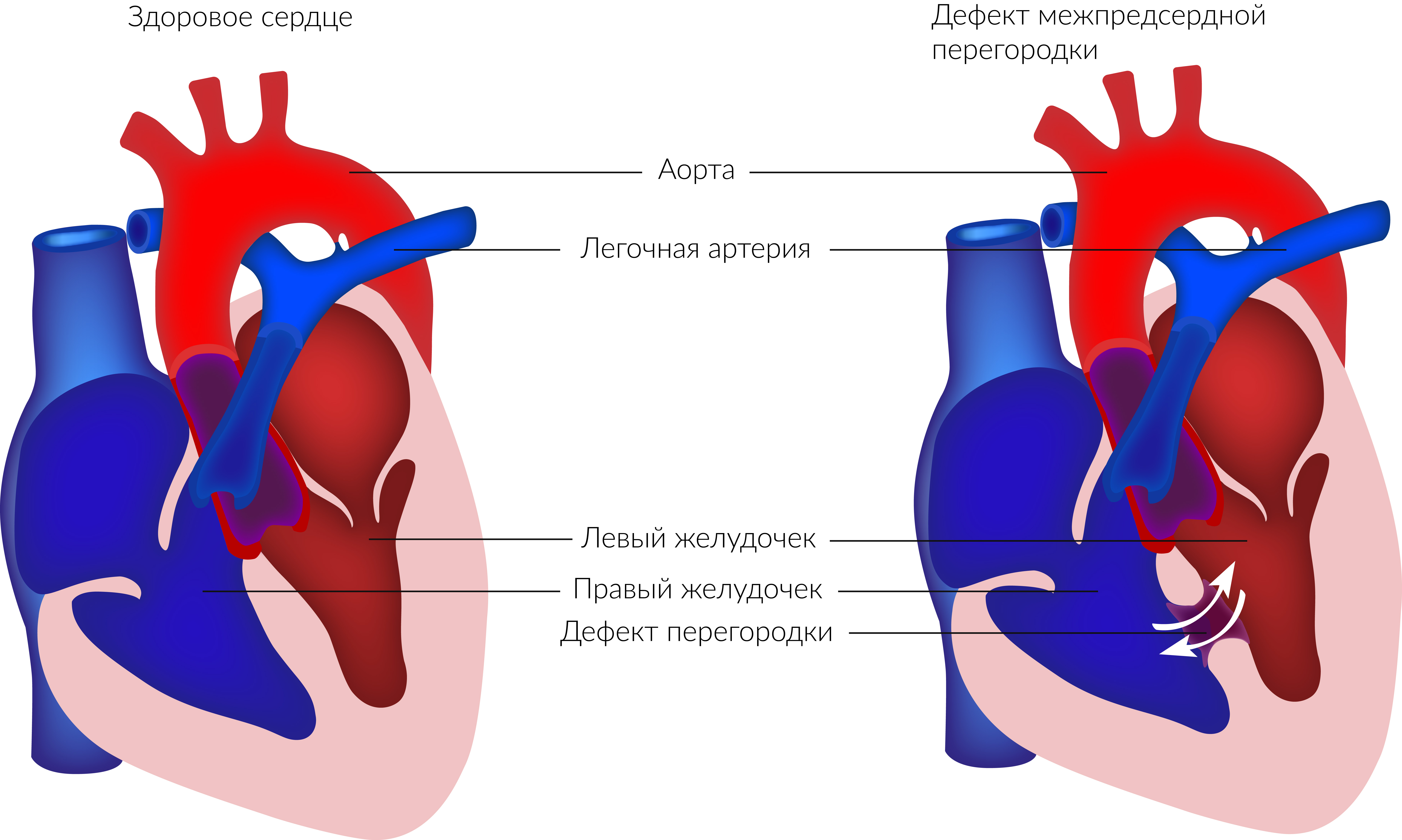 Дефект межпредсердной перегородки.jpg