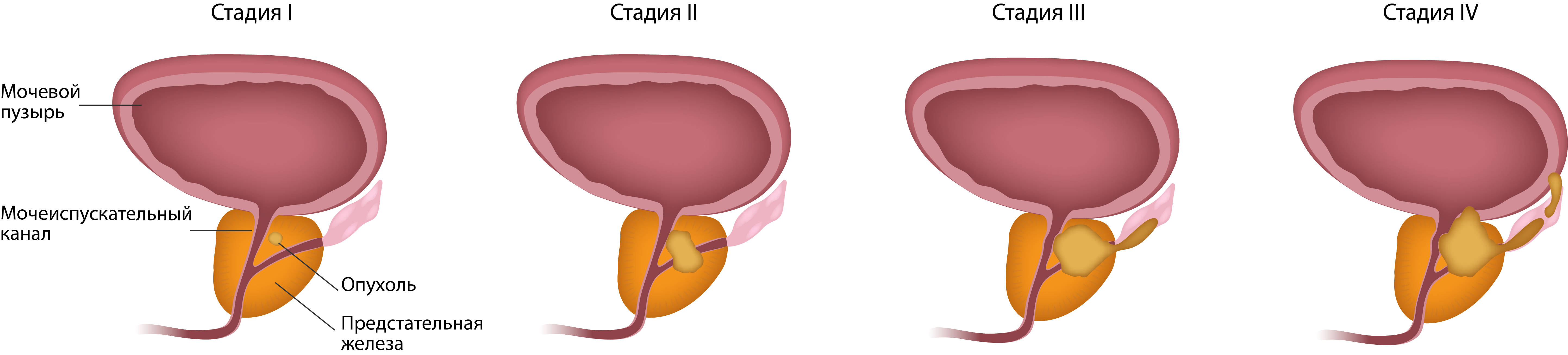 prostata-tumor.jpg